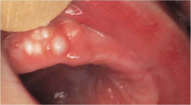 Bohn’s nodules OziDent