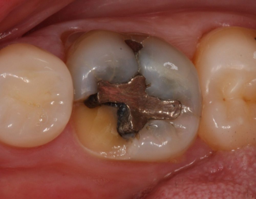 fractured-molar - OziDent