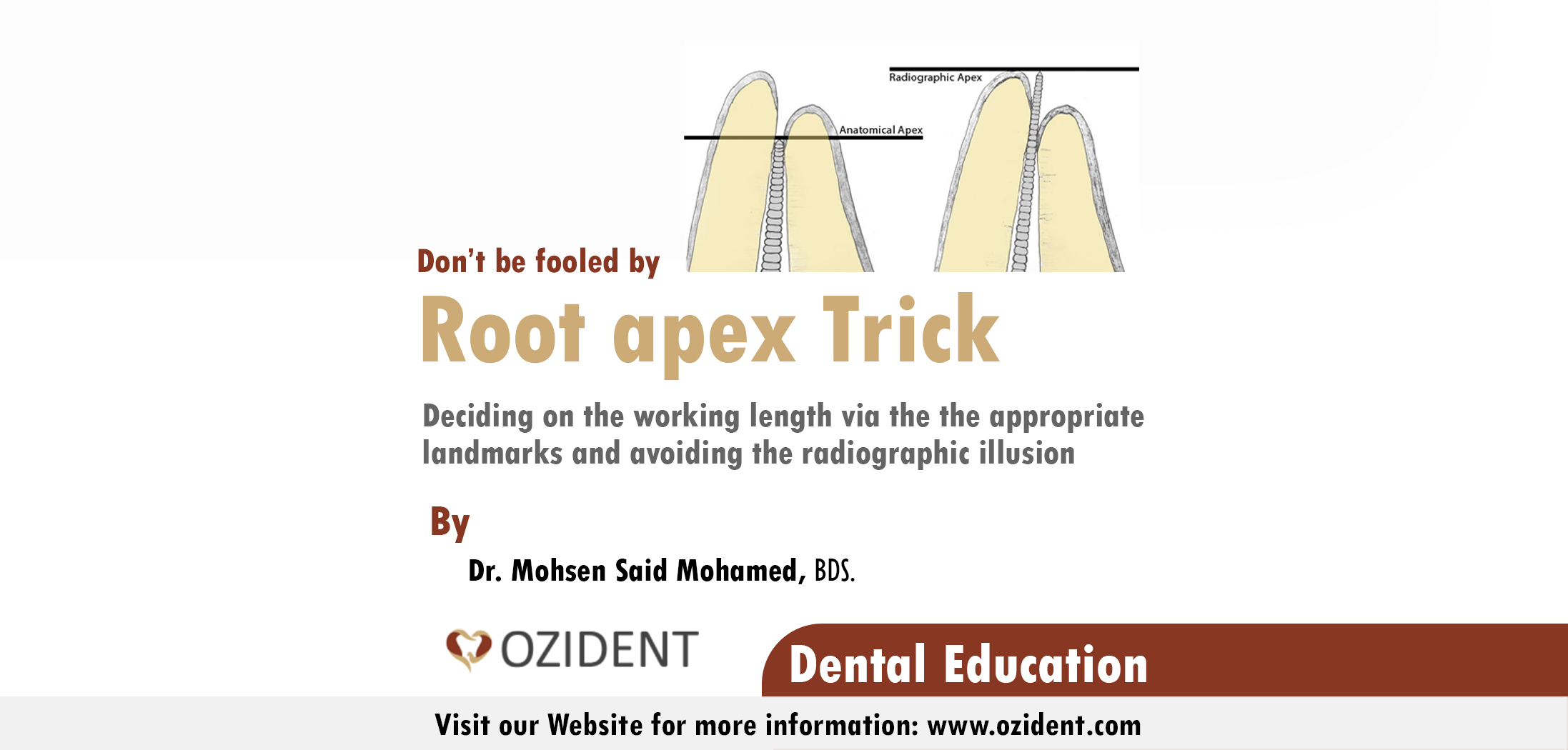 the-apex-trick-root-canal-landmarks-ozident